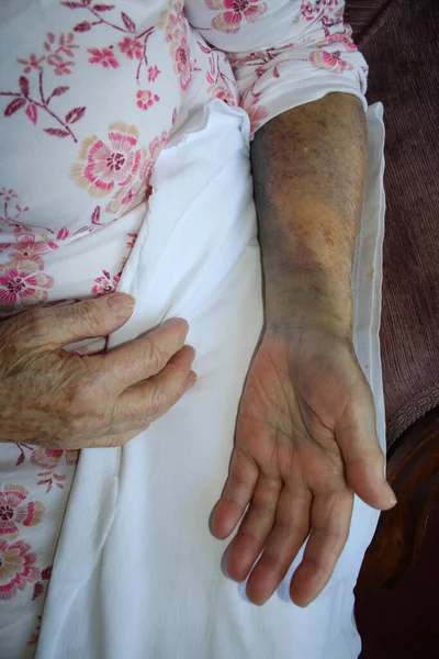 Close up of elderly woman with broken humerus arm out of sling, the wrist fingers hand and all of limb with black yellow bruising  and swollen after bad fall on old persons return from hospital care