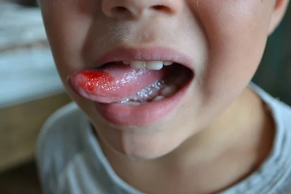 Close-up van lippen, tong, uitstulping van bloed. Childs gebeten tong. — Stockfoto