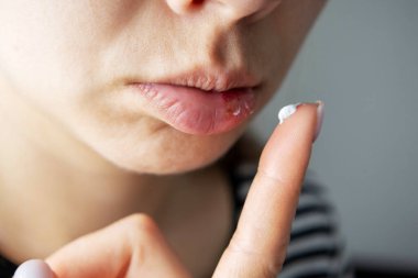 Dudağında uçuk olan uçuğa tıbbi krem süren bir kadın. Virüs tedavisi kavramı.
