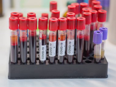 Tek kullanımlık tüpler, kovid 19 testi için venöz kan.