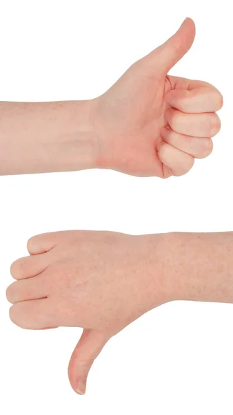 Freckled White Hands Hands Make Thumbs Gesture View Front Back — Stock Photo, Image