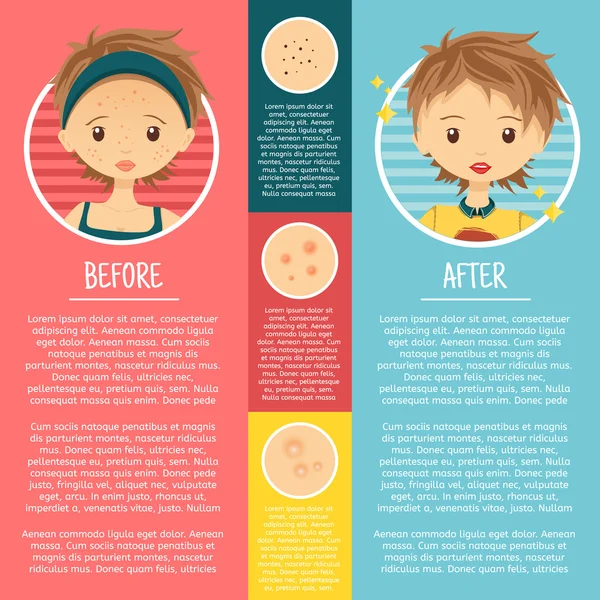 Infografik auf Problemhaut mit Illustrationen Mädchen mit Pickel, Poren, Akne vor und nach. Vektor. — Stockvektor