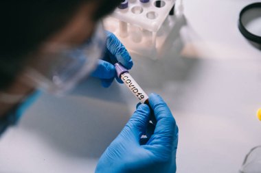 Doktor Coronavirus 2019 nCoV kan örneğini tutuyor. Aşı kavramı, Covid 19 tanı. Teşhis ve laboratuvar. Pozitif koronavirüs testi yapan bir bilim adamı. Virüs bulaşmış. Salgın