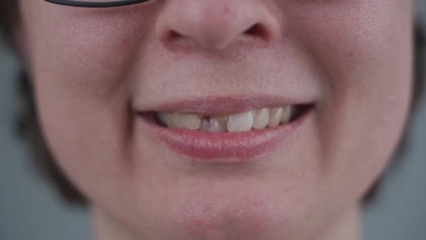 Tema restauración de dientes después de chips, trauma y daño. Mujer sonriente de cerca con el diente delantero partido por la mitad con pasador de resina. Restauración de dientes con alfileres de fibra de vidrio. Concepto de odontología protésica — Vídeos de Stock