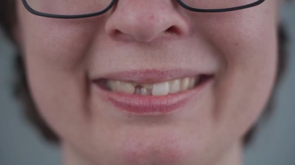 Mulher branca jovem sorridente com dente dianteiro quebrado do qual os pinos de fibra de vidro se salientam. Lesão dentária, dente lascado, metade após acidente. Odontologia e tratamento maxilofacial. Trauma dentário — Vídeo de Stock