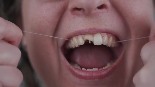 Mujer adulta con dientes rotos utiliza hilo dental. Importancia de la higiene dental. Tema de atención a la limpieza de la cavidad oral. Dientes sanos y malos. Cuidado dental. Diente dañado. Tratamiento dental — Vídeo de stock