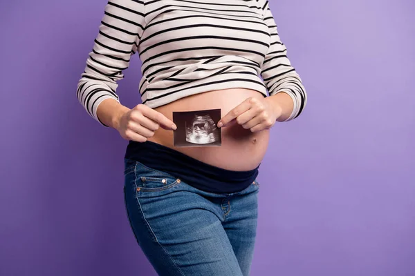 Foto recortada de la señora embarazada demostrar rayos X escanear usar camisa a rayas aislado color violeta fondo — Foto de Stock