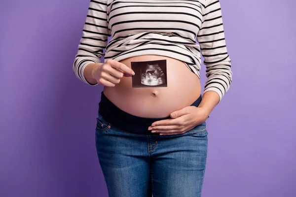 Foto recortada de senhora grávida mostrando ícone de raio-x mão abdômen usar camisa listrada isolado cor roxa fundo — Fotografia de Stock