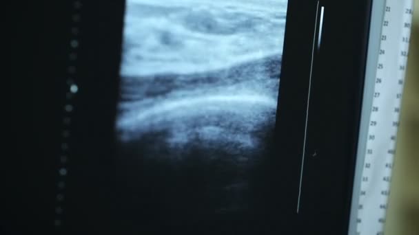 Ultraschallüberwachung im Krankenhaus — Stockvideo