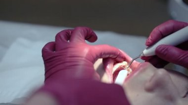 Ultrasonik diş beyazlatma