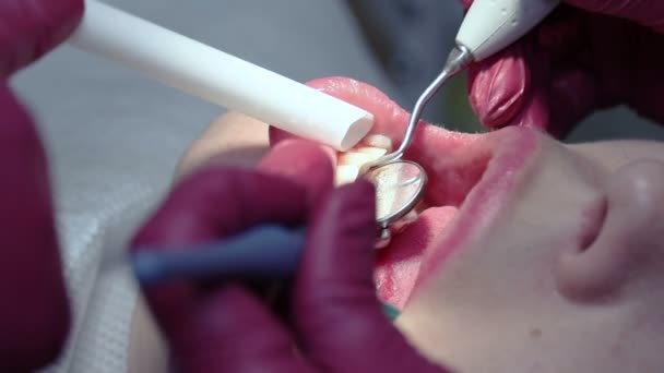 Відбілювання зубів ультразвукові — стокове відео