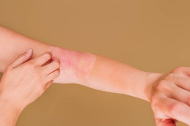 Kadının kolu, bağışıklık yetmezliğinden dolayı kızarık ve cildinde kızarıklık gösteriyor. Rahatlamak için kaşınıyor. Cilt sorununa odaklan