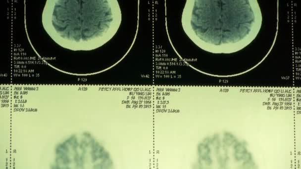 Tomografia ruchoma głowy, tomografia czaszki, rentgen mózgu. — Wideo stockowe