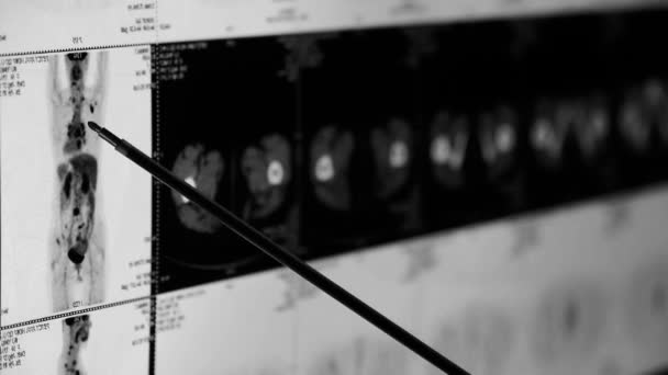 Lékař studie lidské orage & kosti pet-ct scan, X-ray, Rakovina metastázy. — Stock video