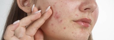 Genç bir kadının yüzünde sivilce var. Yakın plan. Sivilce derisi makrosu. Sivilce tedavisi konsepti. Kadın derisinde sivilce. Sivilce cilt üzerindeki gözenek dokusu sivilce ayrıntıları.