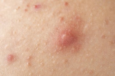 Şişmiş deride sivilce makrosu var. Dermatoloji için sivilcelerin yakın çekim detayları. Deride sivilce makro dokusu. Deri sorunu. Sivilcelere yakın çekim. Ergenlik çağında sivilceli cilt. Dermatoloji kavramı