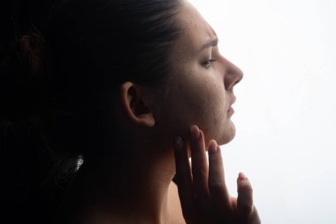 Yüzünde sivilce var. Deri sivilcesi dokusu. Sivilce derisini kapatın. Sorun cilt bakımı. Sivilceler, sivilceler, gözenekler, yüzündeki yaralar. Sivilce tedavisi. Yüzünde sivilceler