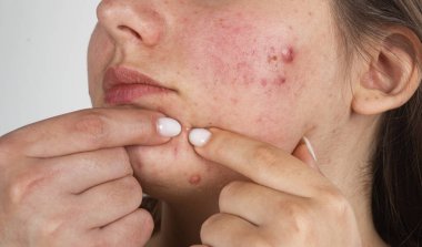 Makroda yüz derisine sivilce sıkıyor. Yanakta sivilce çıkarma. Dermatoloji için gözenekli sivilceler. Yakın planda sivilce sorunu var. Sivilce sıkıyor. Sivilcelere baskı yapar ve parmaklarıyla cildine sivilce çıkarır.