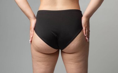 Selülitli kadın. Kalçasında ve bacaklarında selülit olan kadın. Selülit kalça yağ dokusu. Kilo kaybı ve selülit kavramı