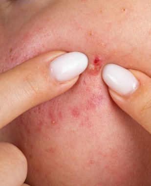 Makroda yüz derisine sivilce sıkıyor. Yanakta sivilce çıkarma. Dermatoloji için gözenekli sivilceler. Yakın planda sivilce sorunu var. Sivilce sıkıyor. Sivilcelere baskı yapar ve parmaklarıyla cildine sivilce çıkarır.