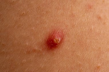 Sivilce, sivilce ve gözenek dokusu detaylarıyla cilt problemini kapatır. Sivilcelerdeki sivilceler sebum, Codone ve Whitehead 'i gösteriyor. Sivilcelere kızarıklık, papüle ve ciltte leke.