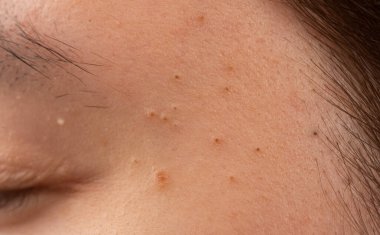 Alnında sivilce ve gözenek dokusu olan sivilceler. Kır Saçlı cilt detayı. Akne lekesi ve cilt bakımı için gözenekler. Deri sorununu sebum ve akne ile kapat