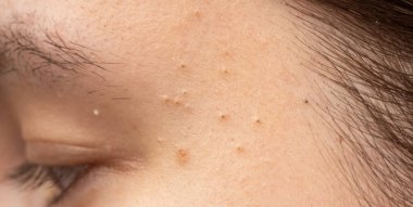 Alnında sivilce ve gözenek dokusu olan sivilceler. Kır Saçlı cilt detayı. Akne lekesi ve cilt bakımı için gözenekler. Deri sorununu sebum ve akne ile kapat