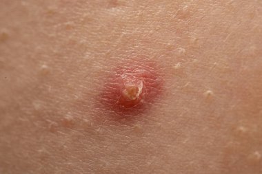 Sivilce sorunlu ve gözenekli sivilceleri kapat. Sivilceler sivilce, siyah nokta ve sebum detaylarıyla kapanır. Sivilce dermatoloji için yakın çekim. Papüllerle sivilce derisi sorununu kapat.