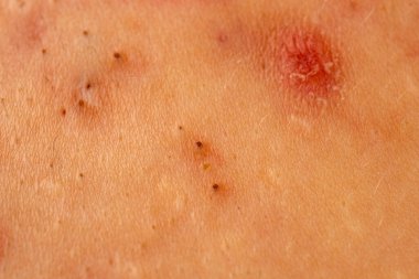 Sivilce ve gözenekli deri dokusunu kapatın. Sivilce, sivilceli sivilceleri gösteriyor. Kır saçlı ve sebum. Sivilceler cilt bakımı için sivilceleri kapatır. Sivilce sorunu olan papülleri kapat