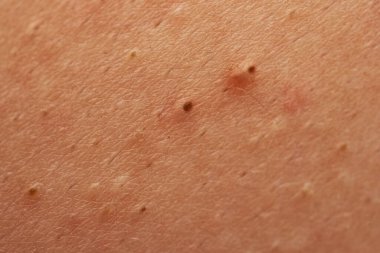 Sivilceler sivilce, siyah nokta gözenekleri ve deride sebum ile kapanır. Ergenlik cildi sorunu için sivilce kapanmış deri dokusu detayı. Sivilceli sivilce, papüller ve folikül iltihabı. Sivilce makrosu