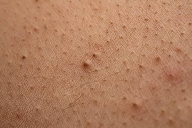 Sivilce, sivilce ve gözenek dokusu detaylarıyla cilt problemini kapatır. Sivilcelerdeki sivilceler sebum, Codone ve Whitehead 'i gösteriyor. Sivilcelere kızarıklık, papüle ve ciltte leke.