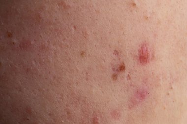 Cilt üzerinde sivilce. Deri üzerinde akne makro sivilce. Gözeneklerdeki sivilce dokusu. Dermatoloji için akne makrosu
