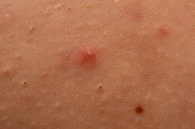 Sivilceler sivilce, siyah nokta gözenekleri ve deride sebum ile kapanır. Ergenlik cildi sorunu için sivilce kapanmış deri dokusu detayı. Sivilceli sivilce, papüller ve folikül iltihabı. Sivilce makrosu