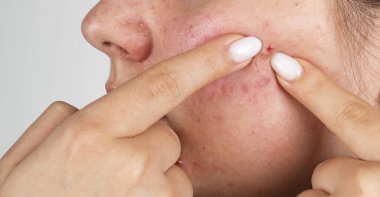 Makroda yüz derisine sivilce sıkıyor. Yanakta sivilce çıkarma. Dermatoloji için gözenekli sivilceler. Yakın planda sivilce sorunu var. Sivilce sıkıyor. Sivilcelere baskı yapar ve parmaklarıyla cildine sivilce çıkarır.