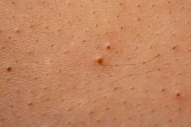 Cilt dokusu detayı için sivilce makrosu kapat. Sivilce, gözenekleri kapat ve ciltte sebum. Sivilceli akne makro, beyaz kafalı ve lekeli. Dermatoloji arka planı için sivilce makrosu