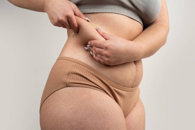 Karın yağlı ve gerçek derili kadın elleri. Kalçasında ve bacaklarında selülit gamzeleri var. Kilo kaybı ve cilt bakımı. Dermatolojiyle birlikte doğal vücut sağlığı