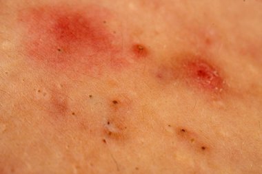 Sivilce, sivilce ve gözenek dokusu detaylarıyla cilt problemini kapatır. Sivilcelerdeki sivilceler sebum, Codone ve Whitehead 'i gösteriyor. Sivilcelere kızarıklık, papüle ve ciltte leke.