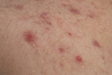 Sivilce ve sivilce, cilde yakın çekim. Akne makro, deride sivilce. Gözeneklerdeki sivilce dokusu. Dermatoloji için sivilce makrosu