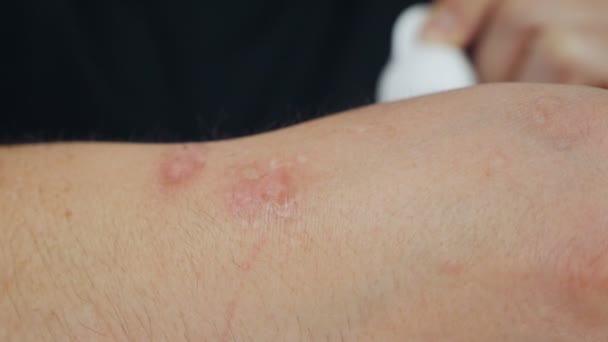 Bradavice na ruce byly ošetřeny speciálním lékem. Bradavice dermatologie ruky lidské kůže zblízka — Stock video