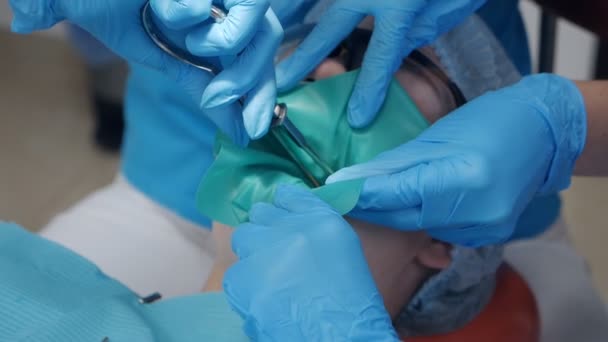 Tandheelkundige behandeling cofferdam in stomatologie. Tandarts met behulp van tandheelkundige dam voor tand isolatie — Stockvideo
