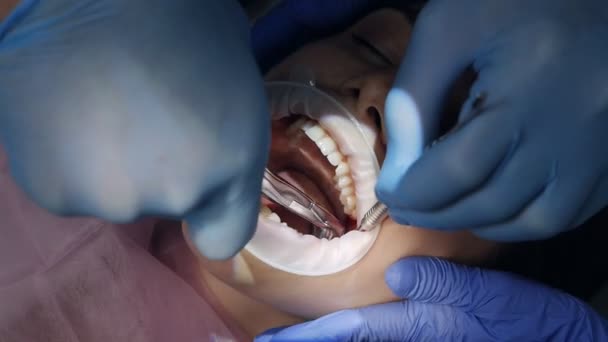 Dentiste utilisant des pinces chirurgicales pour extraire une dent dans le cabinet dentaire. Dent de sagesse extraite recouverte de sang — Video