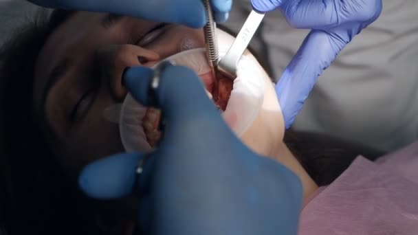 Stitching. Dental surgeon working with a patient in a modern dental clinic — Stock Video