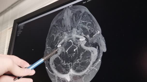 Neuroloog Wijst Naar Zijn Pen Legt Coronale Mri Resultaten Van — Stockvideo