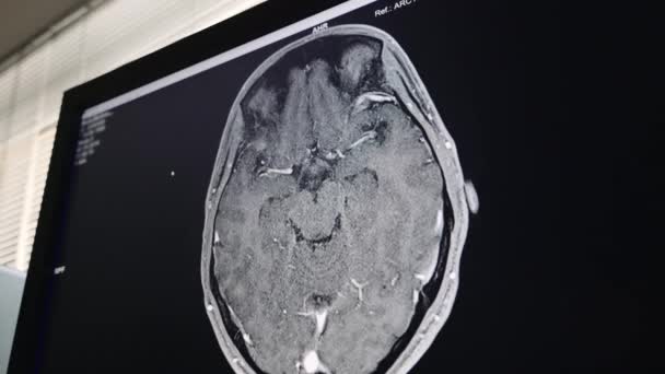 Manyetik Rezonans Görüntüleme Taraması Ekranda Gösterilen Insan Beyninin Koronal Görüntüsünden — Stok video