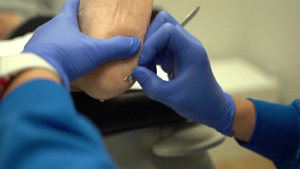 儿科诊所用手术刀摘除脚上的死皮 — 图库视频影像