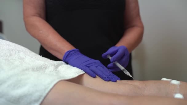 Sclerotherapy Dermatologis Menyuntikkan Solusi Garam Untuk Mengobati Varicose Veins Pada — Stok Video