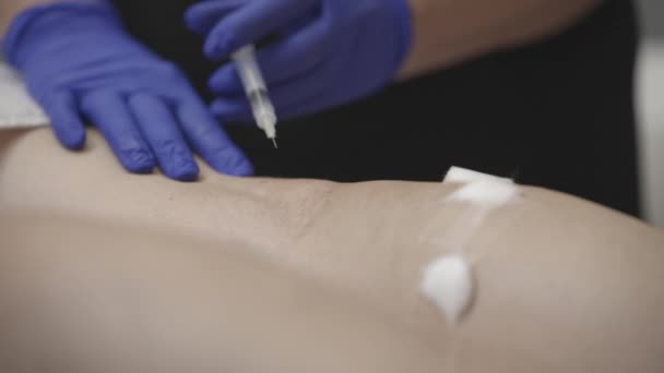 Dermatolog Rękawiczkach Wykonuje Zabieg Skleroterapii Klinice Zbliżenie — Wideo stockowe