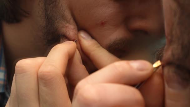 Makro Shot Man Oskubać Włosy Pęsetą Jego Zakrwawionej Skóry Strzał — Wideo stockowe