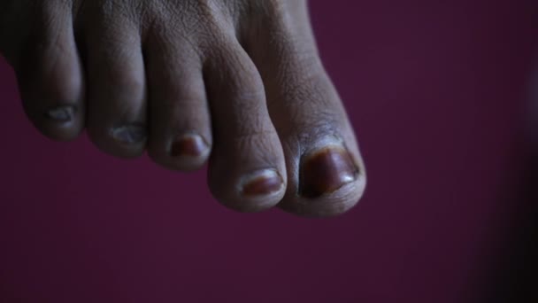Blick Auf Die Zehen Des Rechten Fußes Mit Trockener Haut — Stockvideo