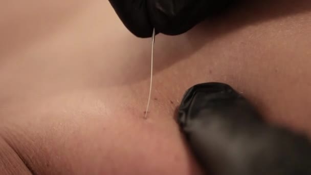 Akupunkteur Sticht Nadel Hautnahaufnahme Hält Die Haut Mit Den Händen — Stockvideo
